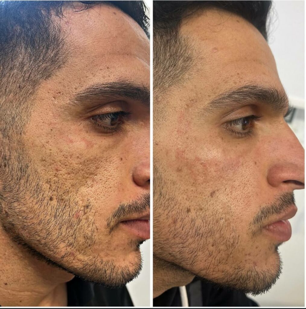 دستگاه co2 فرکشنال