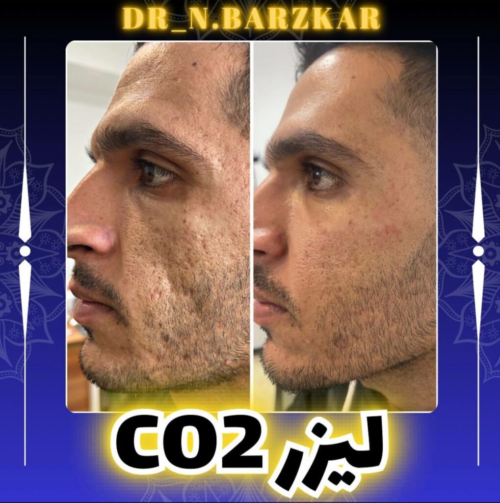 لیزرco2