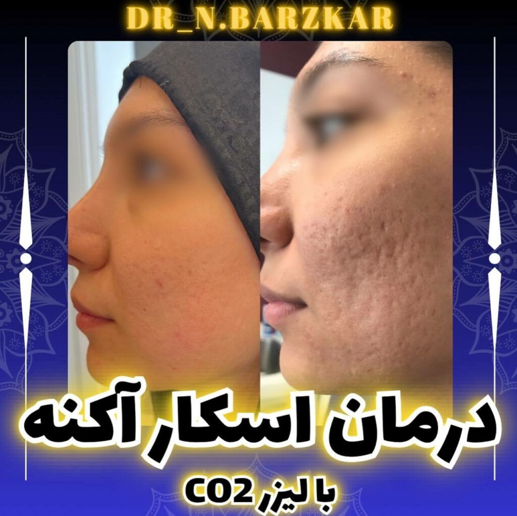 درمان اسکار آکنه