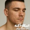 اسکار آکنه
