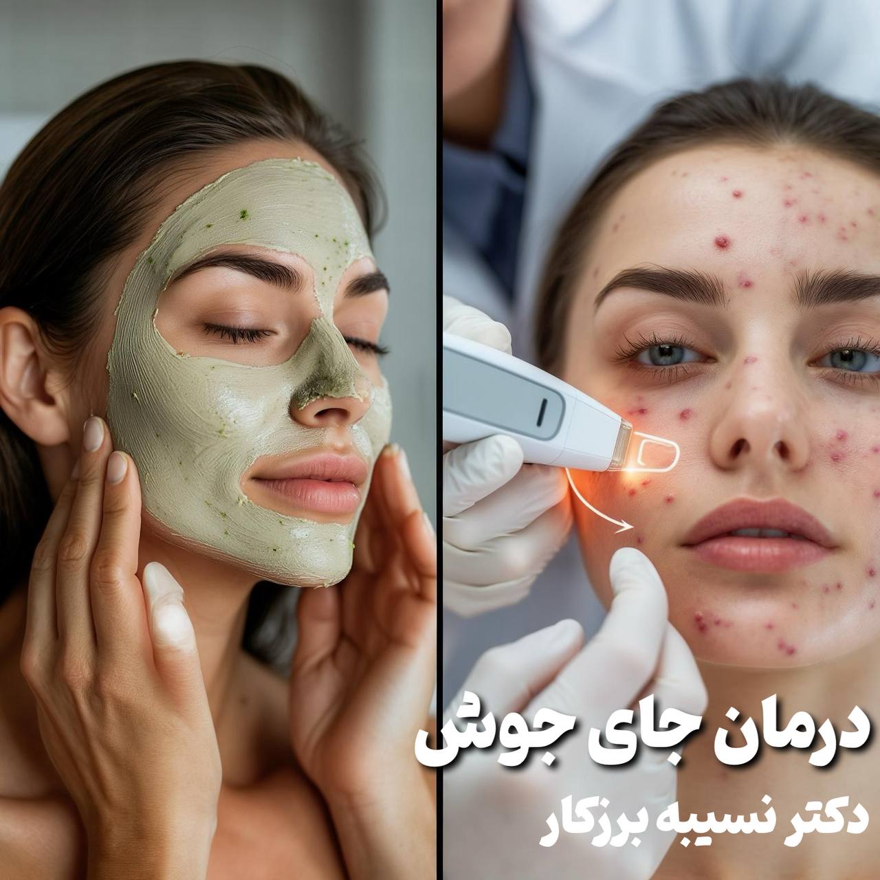 درمان جوش